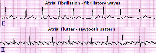 arr atrial_fibrillation